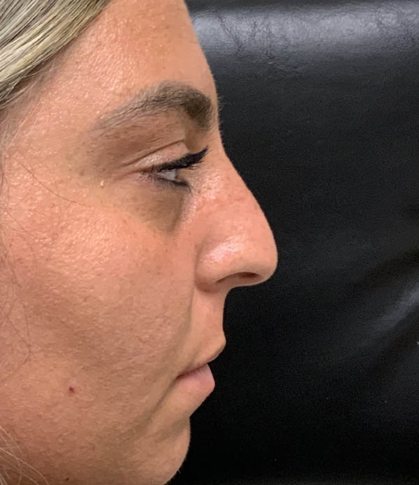 Rhinoplasty