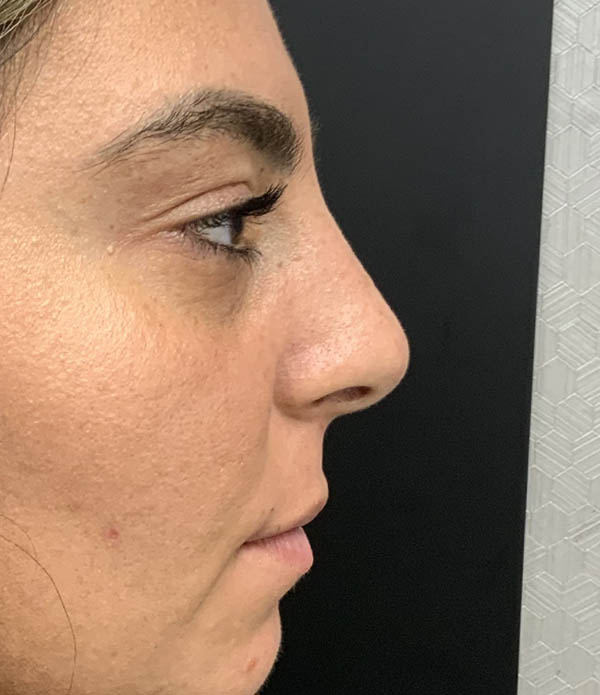 Rhinoplasty