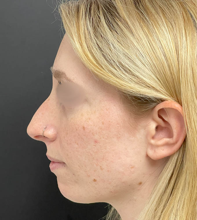 Rhinoplasty