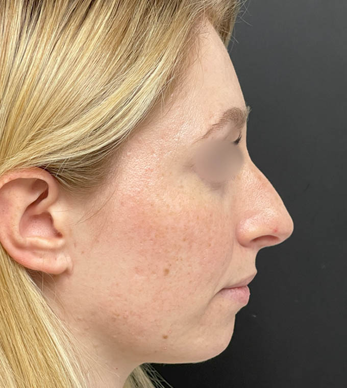 Rhinoplasty