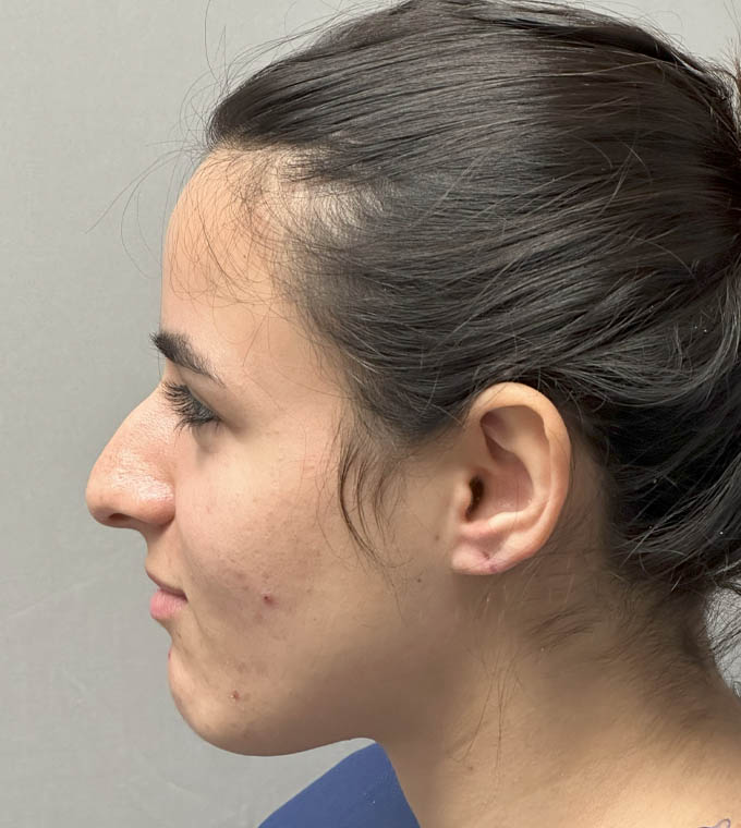 Rhinoplasty