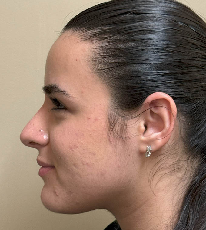 Rhinoplasty