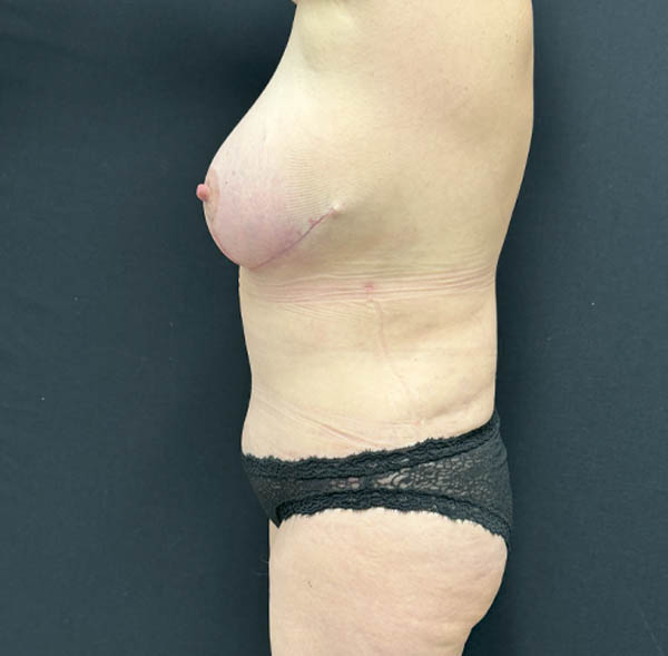 Tummy Tuck