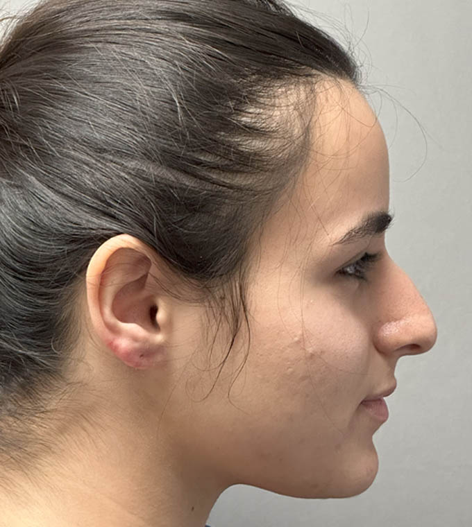 Rhinoplasty