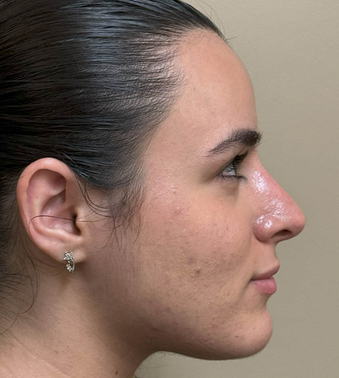 Rhinoplasty