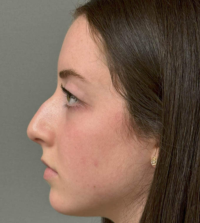 Rhinoplasty