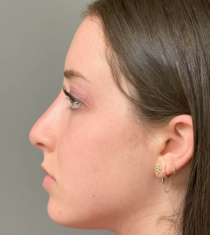 Rhinoplasty