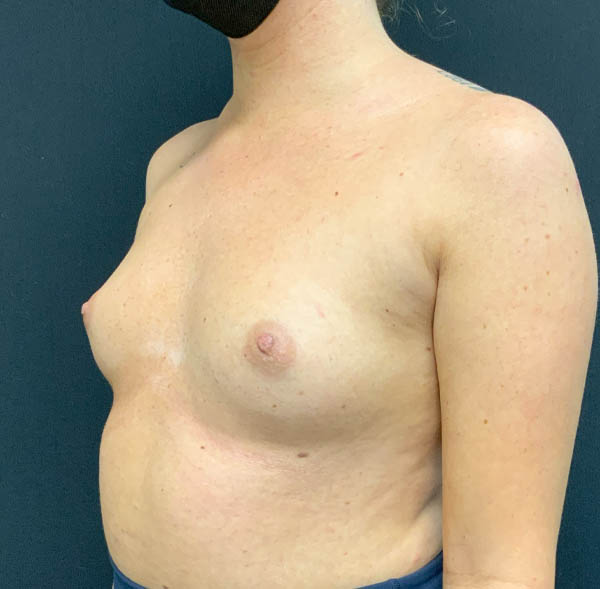 Breast Augmentation