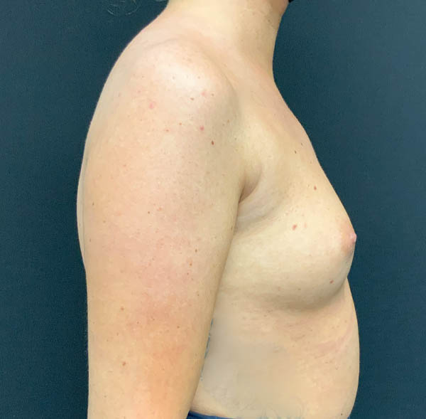 Breast Augmentation