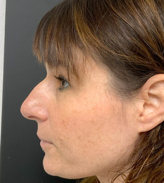 Rhinoplasty