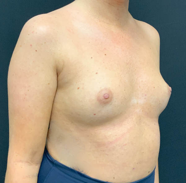 Breast Augmentation