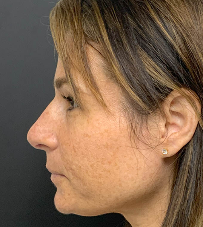 Rhinoplasty