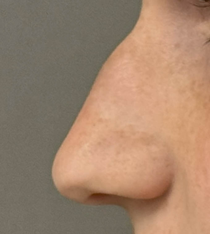 Rhinoplasty