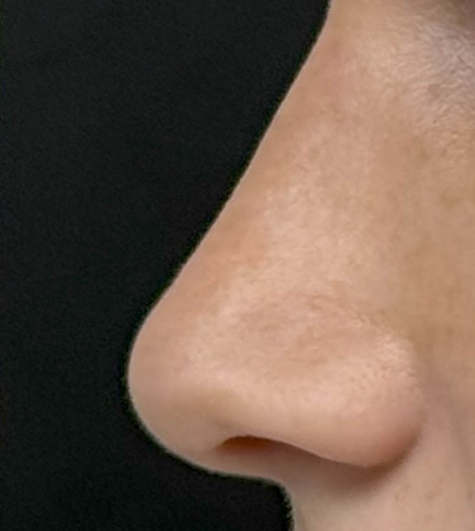 Rhinoplasty