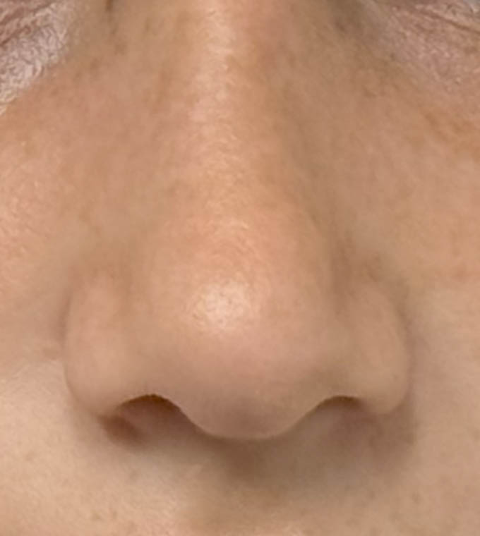 Rhinoplasty