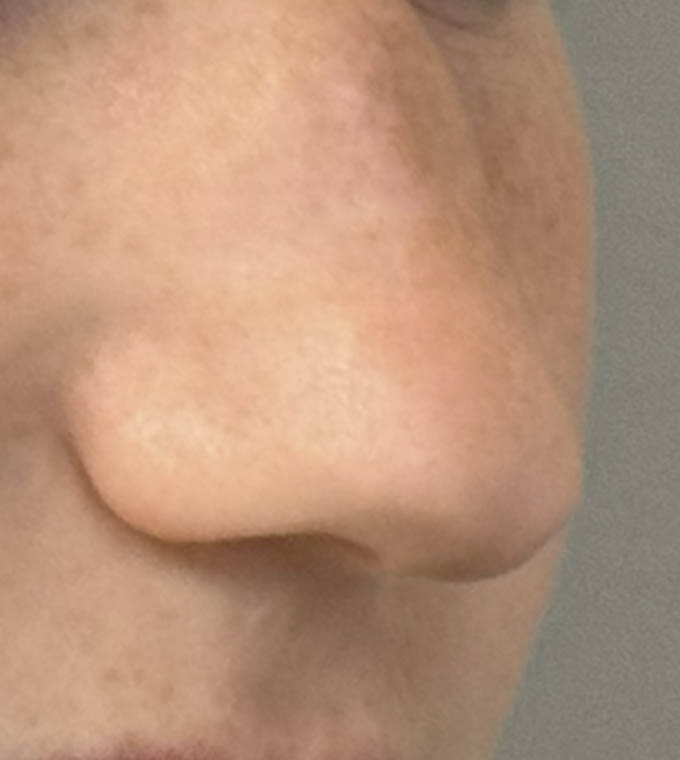 Rhinoplasty