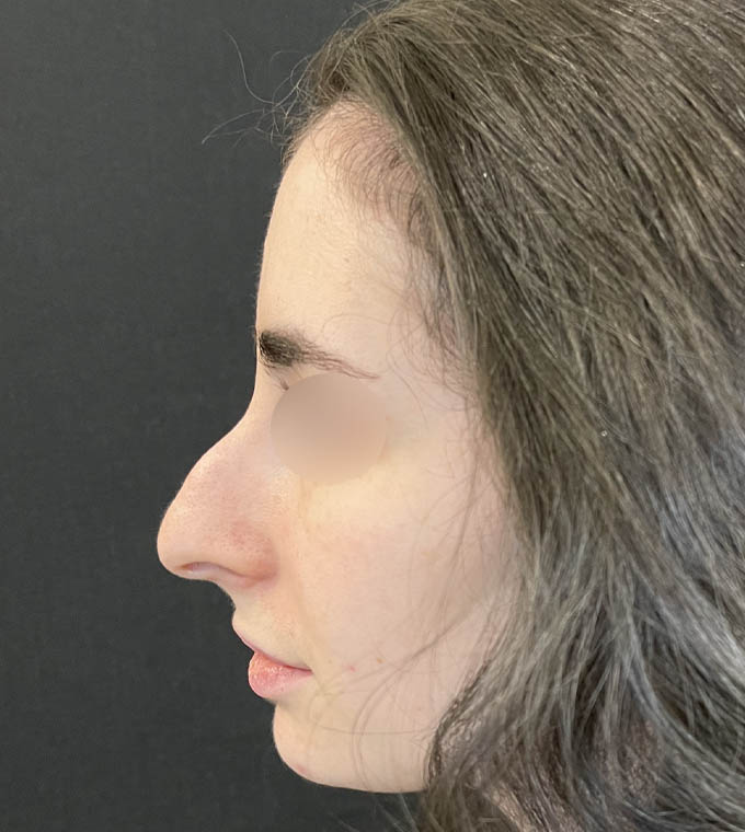 Rhinoplasty