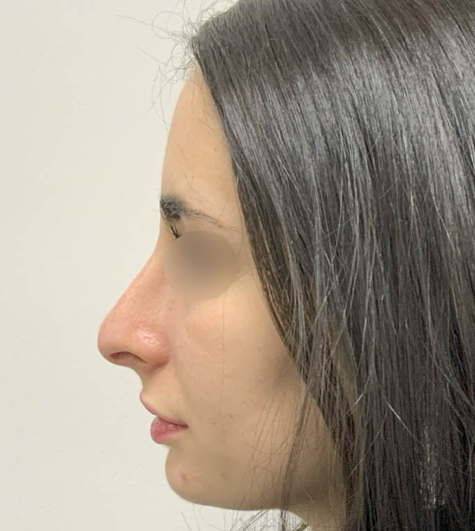 Rhinoplasty