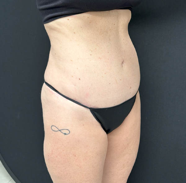 Tummy Tuck